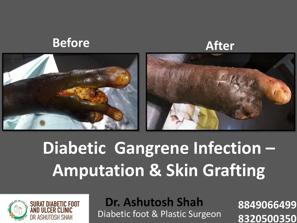 Diabetic Foot  PPT 3 checked by sir.pptx-86.webp